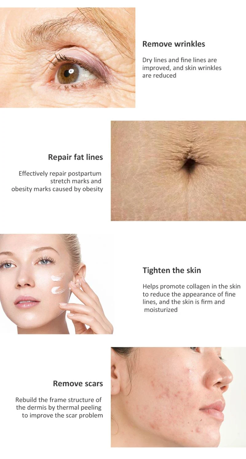 Medical Equipment Skin Resurfacing Scar Removal Vaginal Tightening Fotona 4D Fractional CO2 Laser