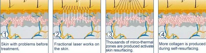 10600nm Laser CO2 30W Stretch Mark Treatment Ance Removal Glass Tube Fractional CO2 Laser Machine